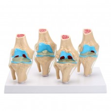 4 Stages pathological Change Knee Joint Model